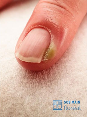 Panaris doigt, symptôme et traitement du panari | SOS Main